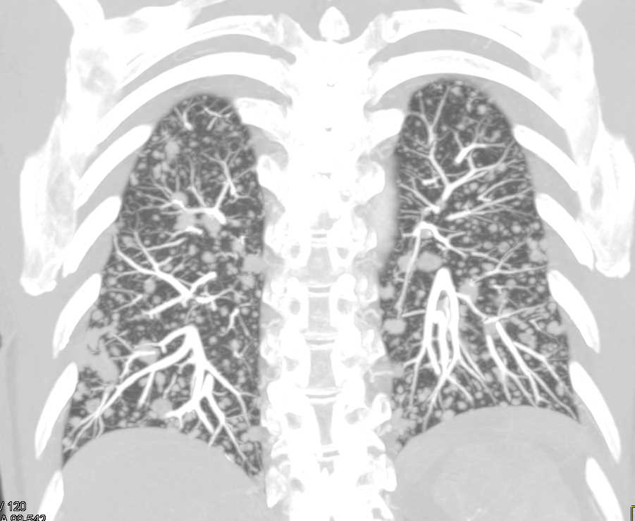Miliary Tuberculosis (TB) - CTisus CT Scan