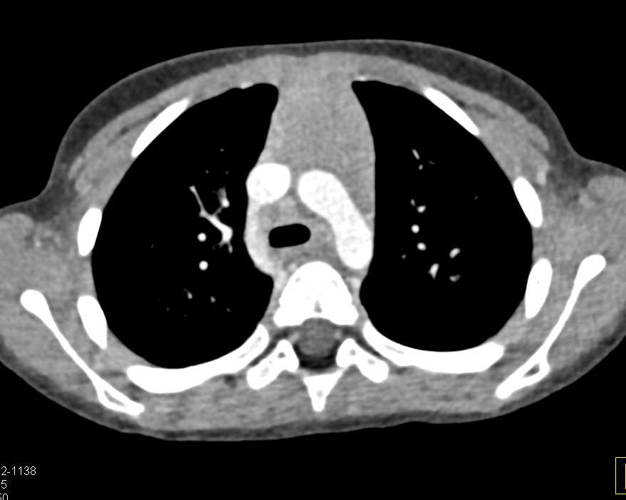 Extensive Adenopathy Compresses the Airway due to Infection - CTisus CT Scan