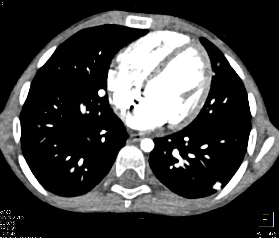 Sarcoma Metastatic to the Lungs - CTisus CT Scan