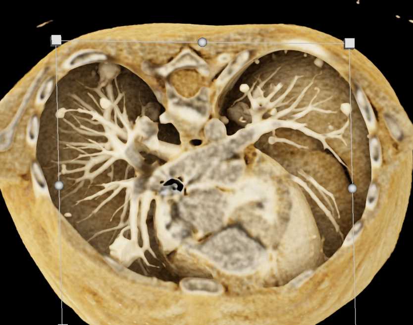 Sarcoma Metastatic to the Lungs - CTisus CT Scan