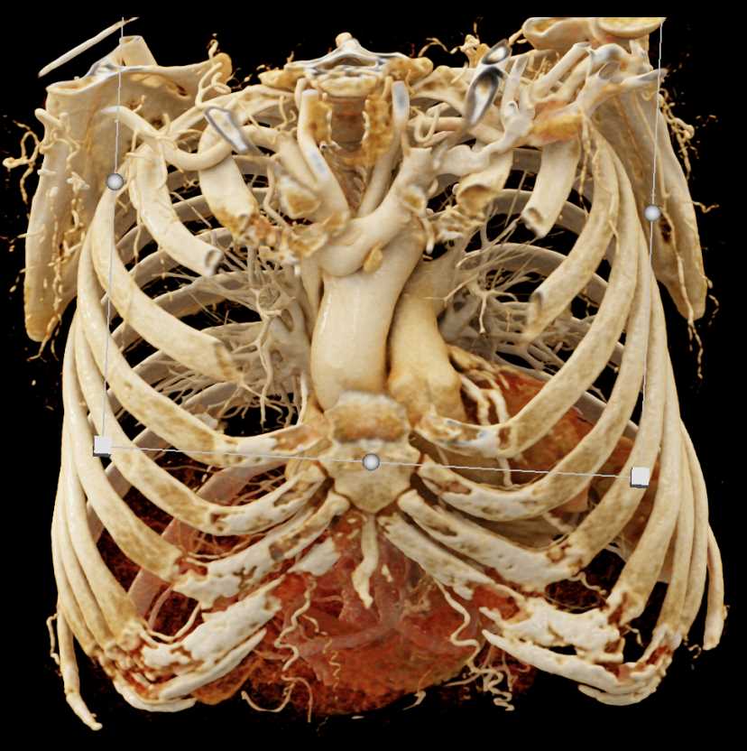 Mediastinal Mass was Ectopic Parathyroid Gland - CTisus CT Scan