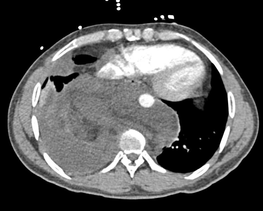 Large Mediastinal Hematoma - CTisus CT Scan