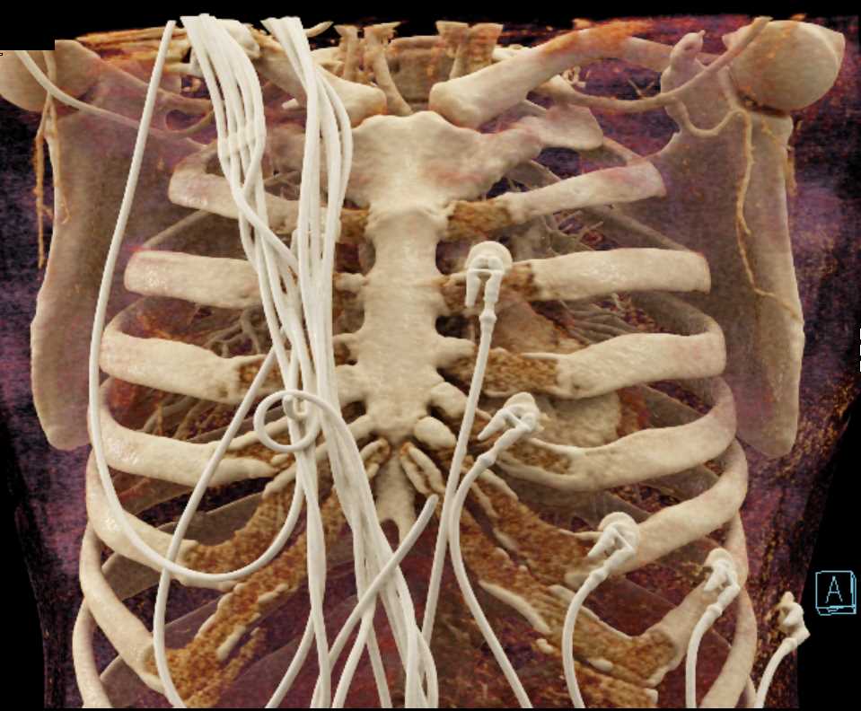 Large Mediastinal Hematoma - CTisus CT Scan