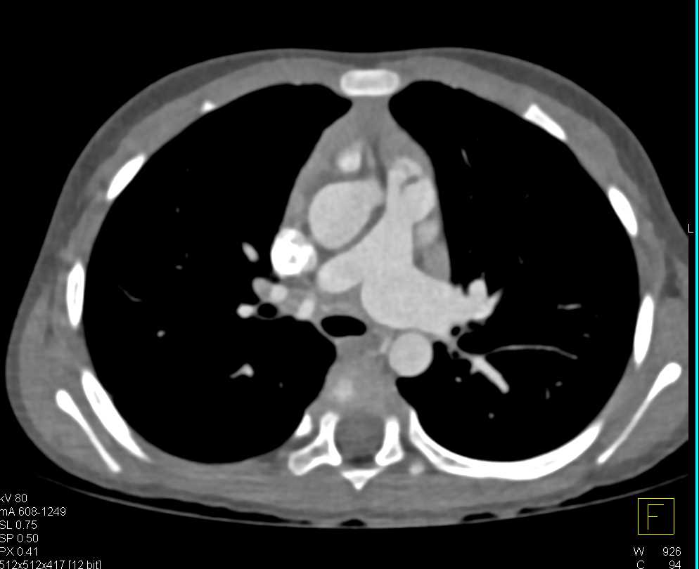 Dilated Bronchial Arteries - CTisus CT Scan