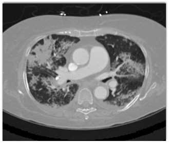 COVID-19 Pneumonia - CTisus CT Scan