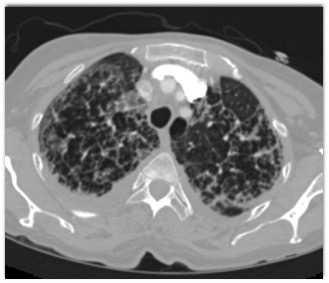 COVID-19 Pneumonia - CTisus CT Scan