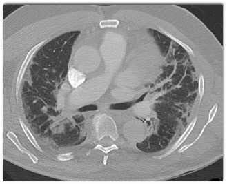 COVID-19 Pneumonia with Pulmonary Embolism - CTisus CT Scan