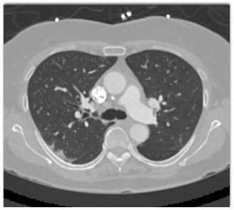 COVID-19 Pneumonia - CTisus CT Scan