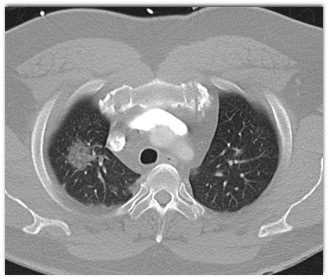 COVID-19 Pneumonia - CTisus CT Scan