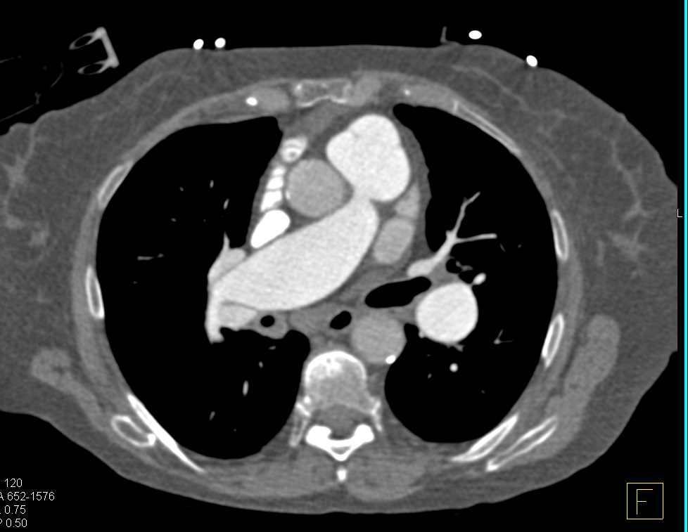 Well Timed Study for Pulmonary Embolism (PE) Detection - CTisus CT Scan