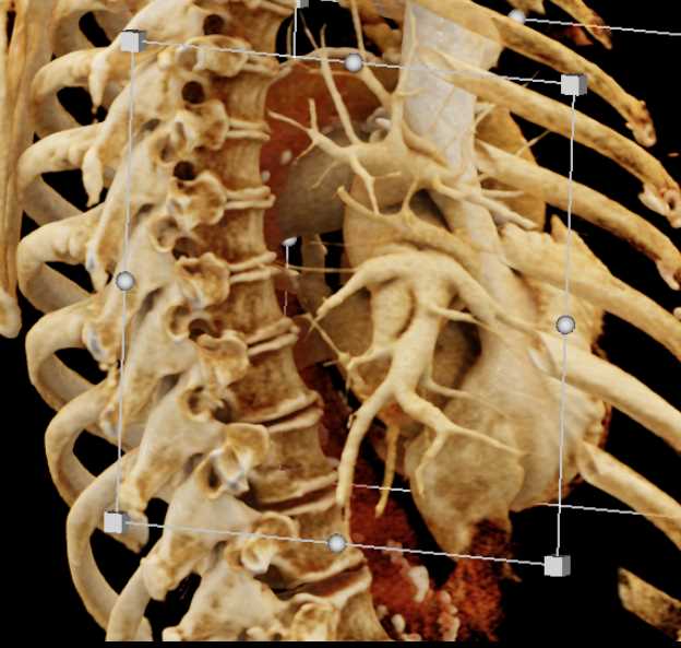 3D of Right Hilum and Pulmonary Arteries - CTisus CT Scan