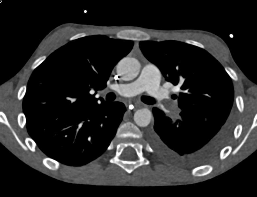 Large Left Pulmonary Embolism - CTisus CT Scan