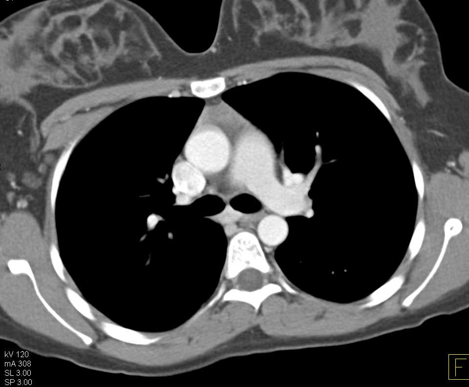 Normal Thymus - CTisus CT Scan