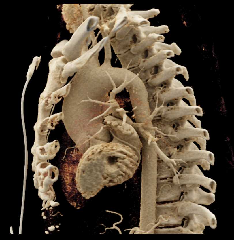 Extensive Aortic Valve Calcification - CTisus CT Scan