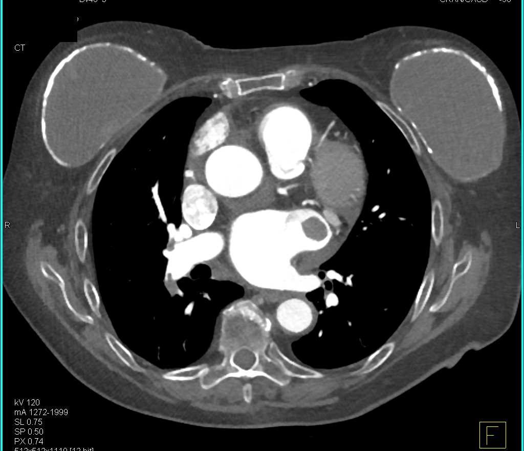 PE and Left Atrial Thrombus - CTisus CT Scan