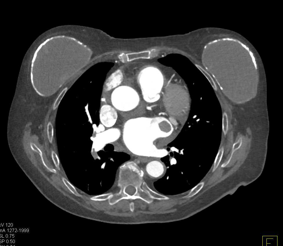 PE and Left Atrial Thrombus in Patient with Bladder Cancer - CTisus CT Scan