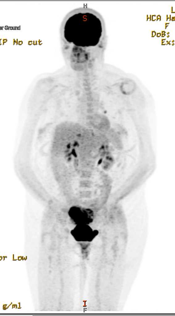 Metastatic Breast Cancer - CTisus CT Scan