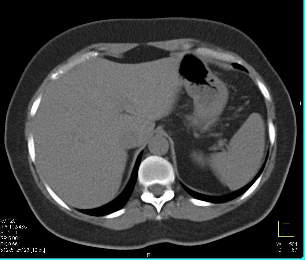 Metastatic Breast Cancer Including Carcinomatosis - CTisus CT Scan