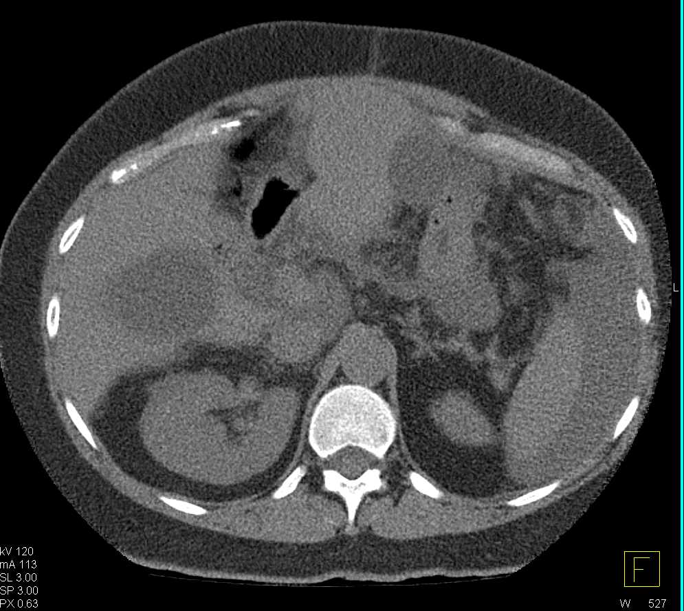 Metastatic Breast Cancer and Carcinomatosis - CTisus CT Scan