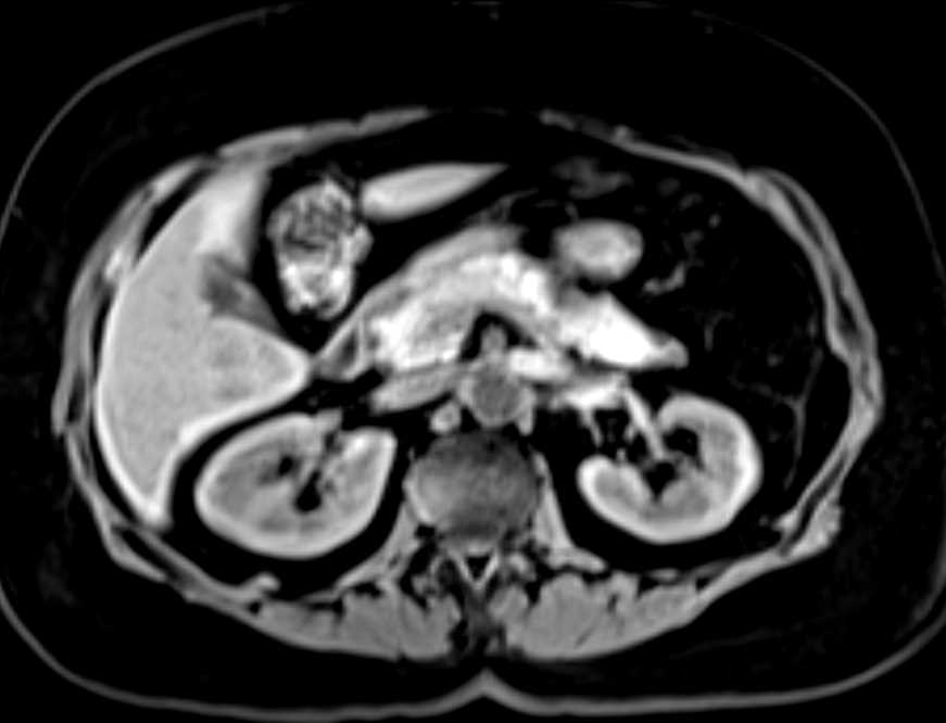 Metastatic Breast Cancer and Carcinomatosis - CTisus CT Scan