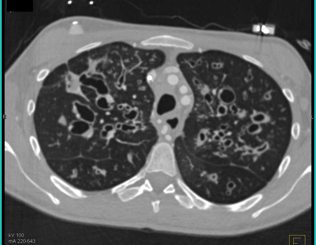 Cystic Fibrosis - CTisus CT Scan