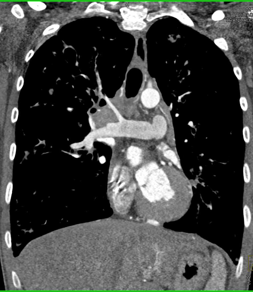 Cystic Fibrosis - CTisus CT Scan