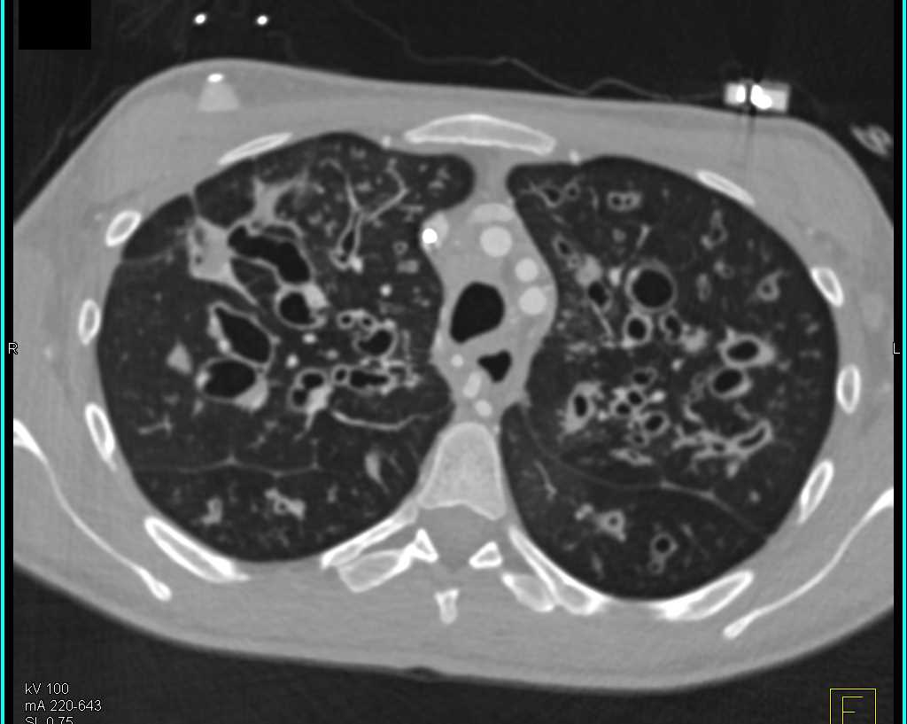 Cystic Fibrosis - CTisus CT Scan