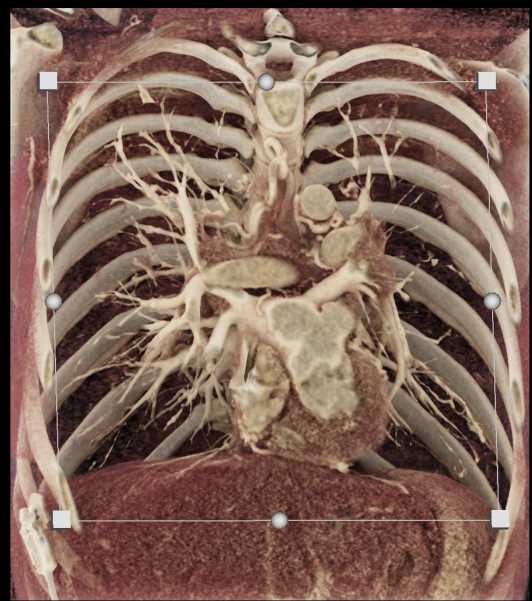 Cystic Fibrosis with Prominent Pulmonary Arteries - CTisus CT Scan