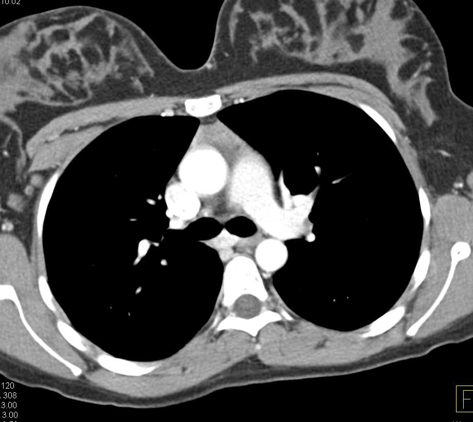 Thymic Hyperplasia - CTisus CT Scan