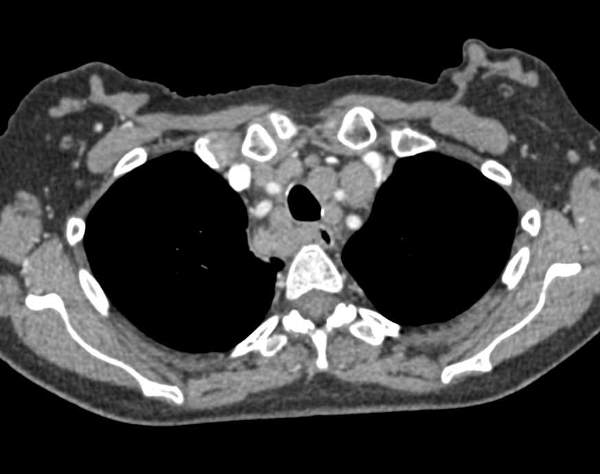 Extensive Adenopathy Consistent with Malignancy - CTisus CT Scan