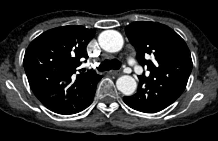 CTisus CT Scanning | Enlarged Bronchial Arteries