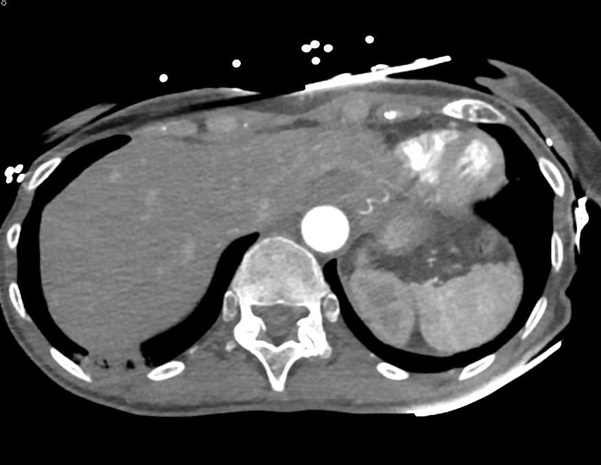 Septic Emboli Right Lower Lung - CTisus CT Scan