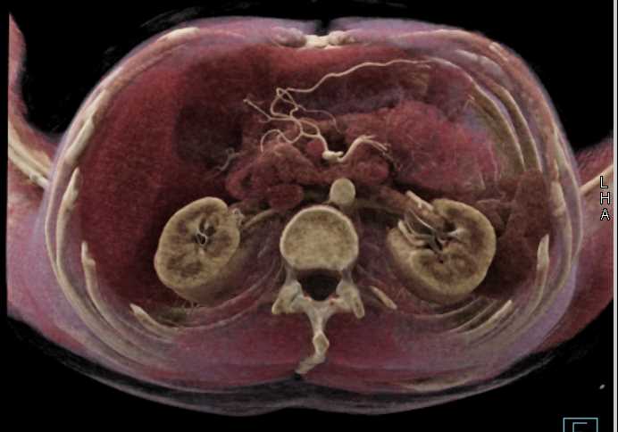 Evaluation of the Mediastinum and Lungs with Multiple Renderings - CTisus CT Scan