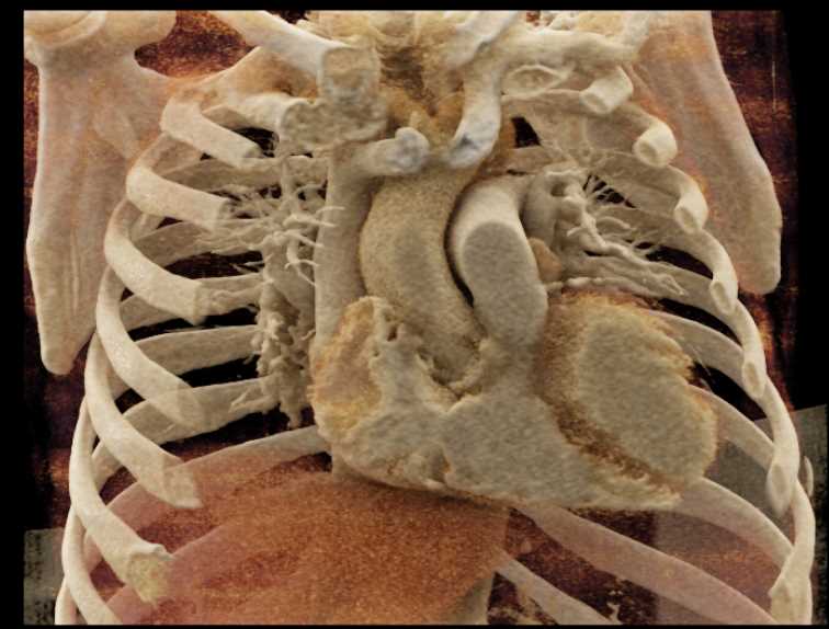 Type A Aortic Dissection - CTisus CT Scan