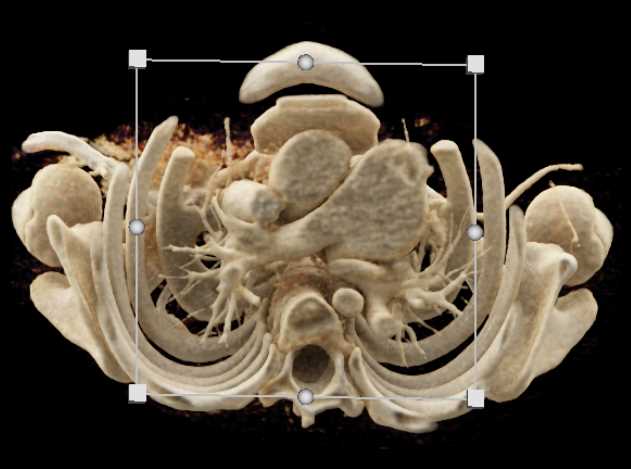 Dilated Main Pulmonary Artery - CTisus CT Scan