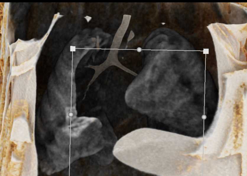 Hyperlucency Left Lower Lung - CTisus CT Scan