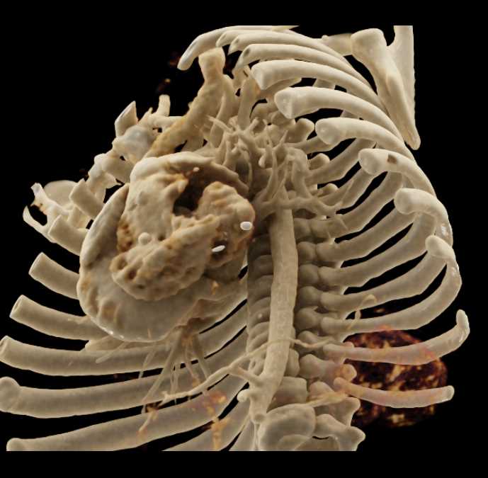 Hyperlucency Left Lower Lung - CTisus CT Scan