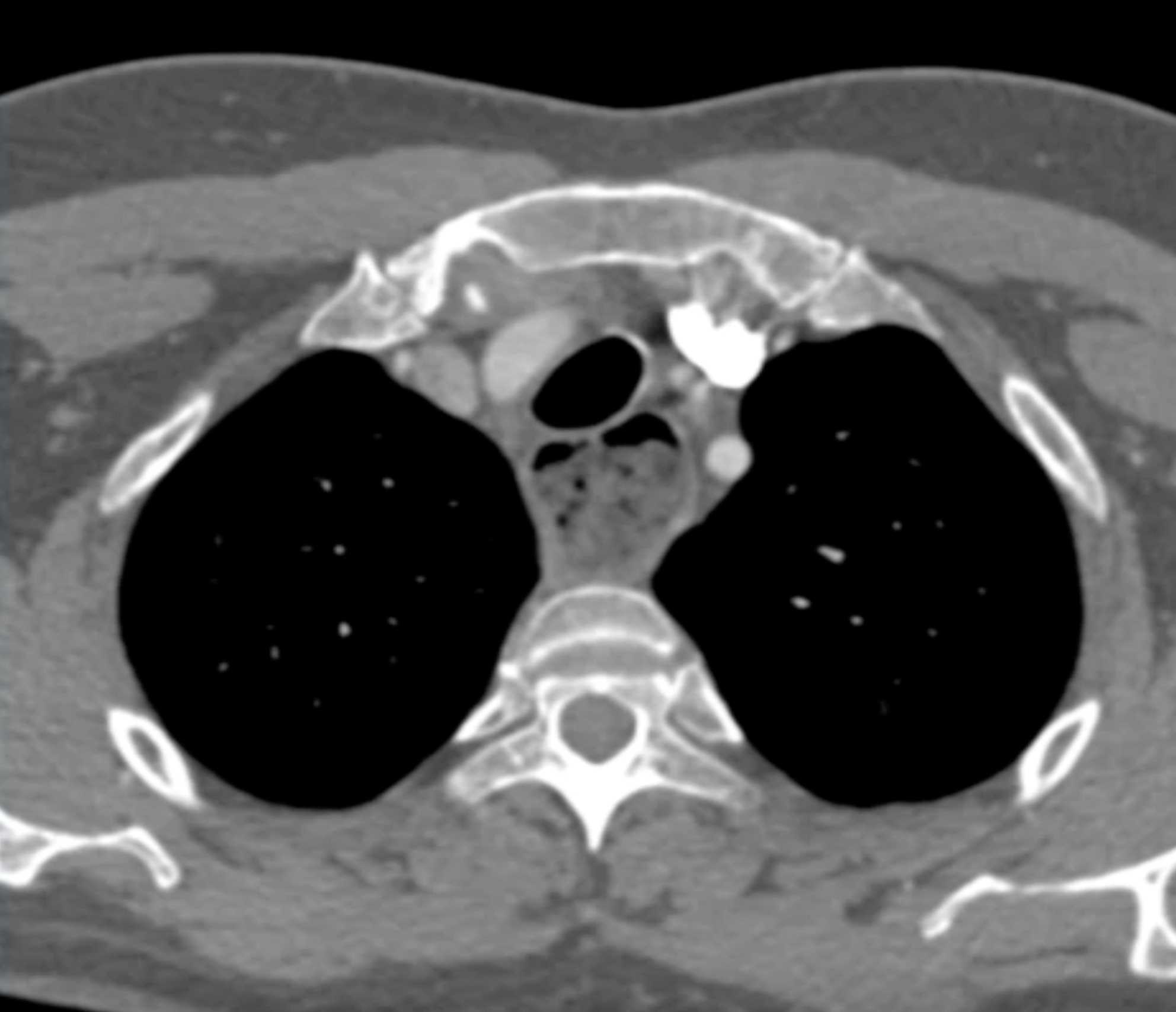 Fibrosing Mediastinitis - CTisus CT Scan