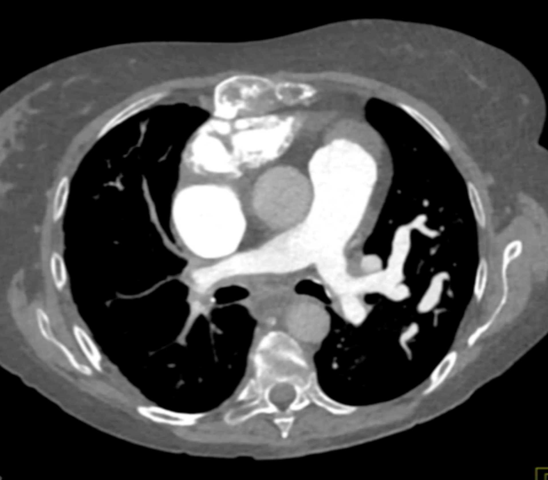 Fibrosing Mediastinitis involves the Pulmonary Artery and Vein - CTisus CT Scan