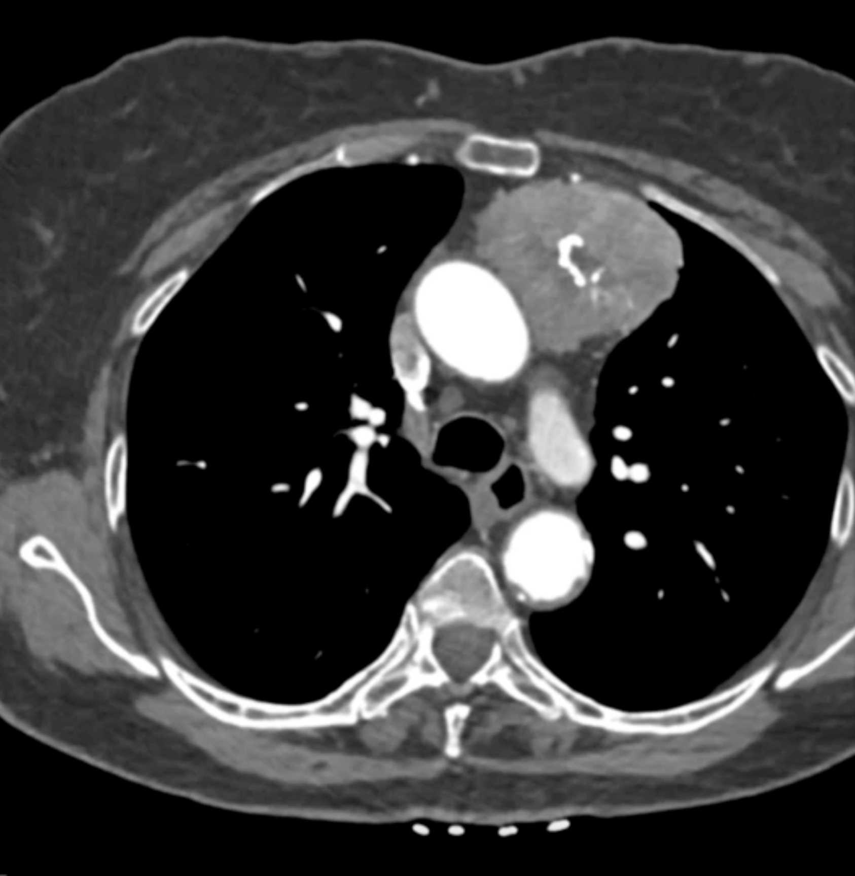 Thymic Carcinoma - CTisus CT Scan