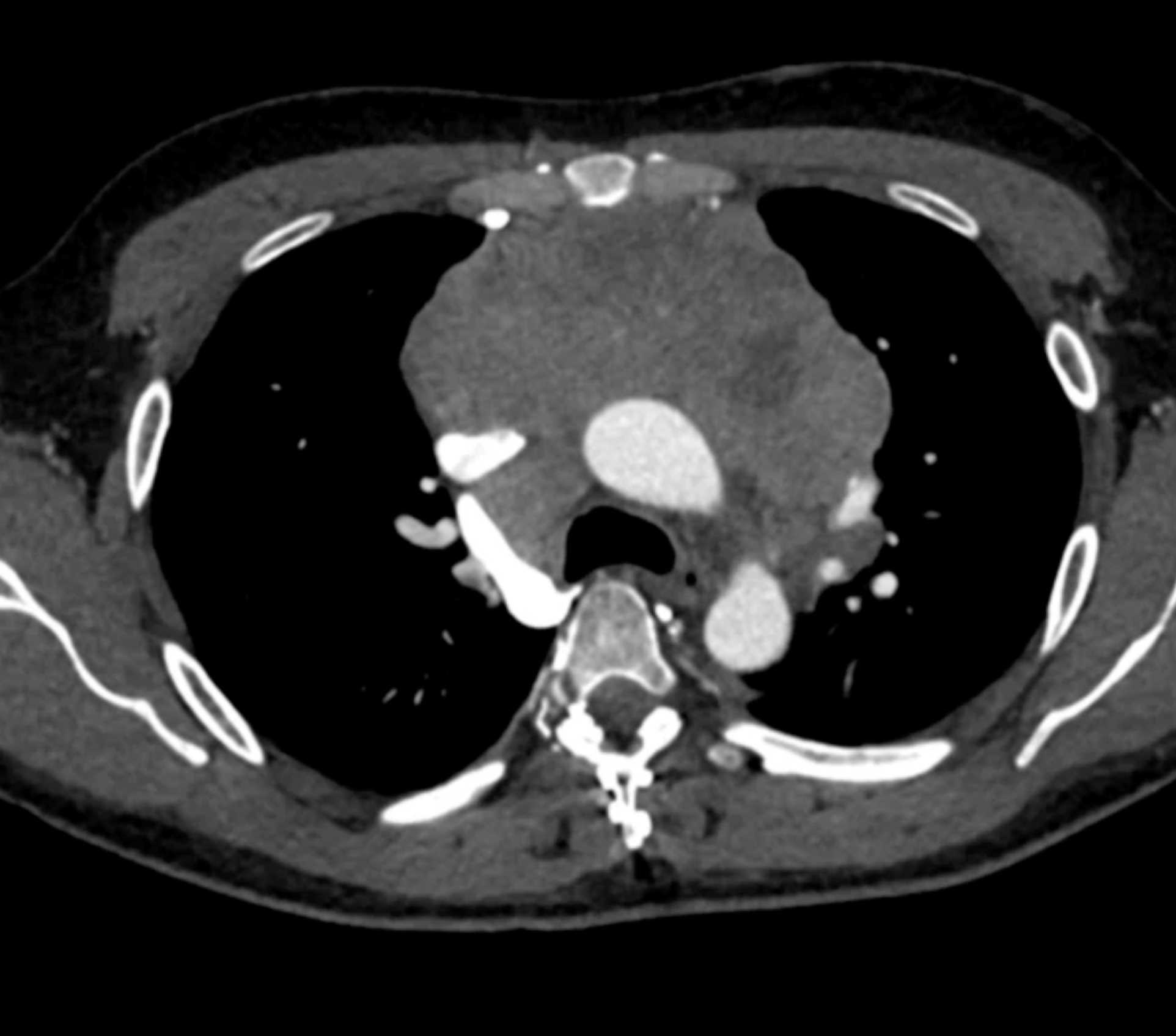 Thymic Carcinoma - CTisus CT Scan