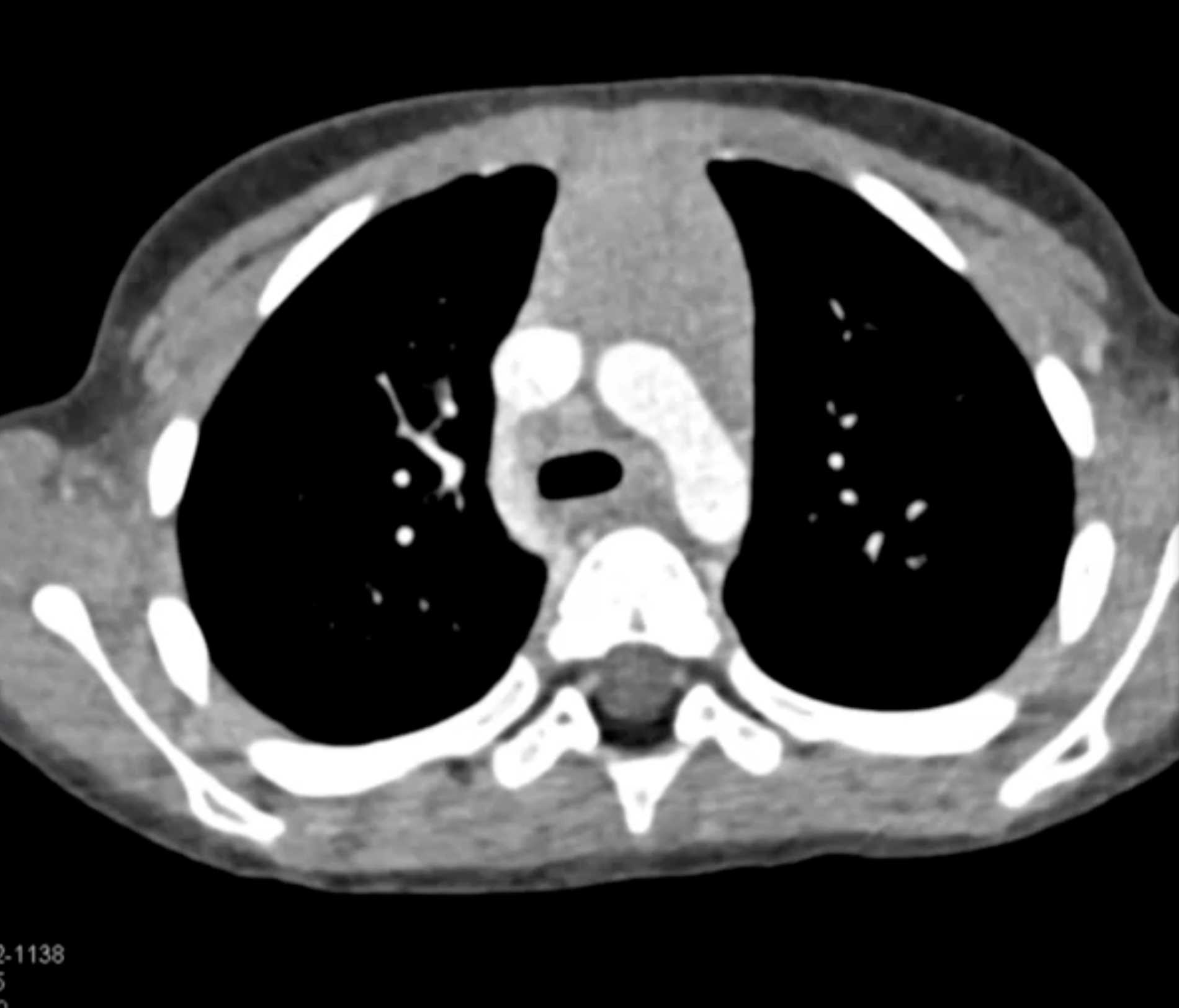Histoplasmosis and Normal Thymus - CTisus CT Scan