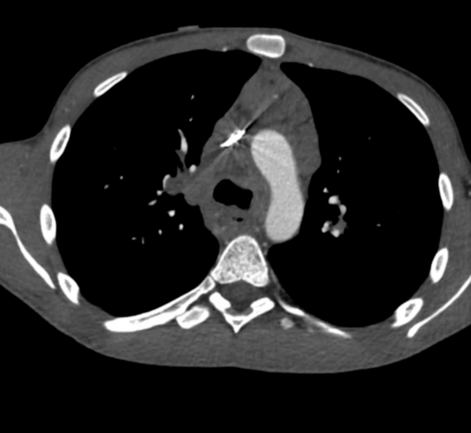 Large Cell Lymphoma - CTisus CT Scan