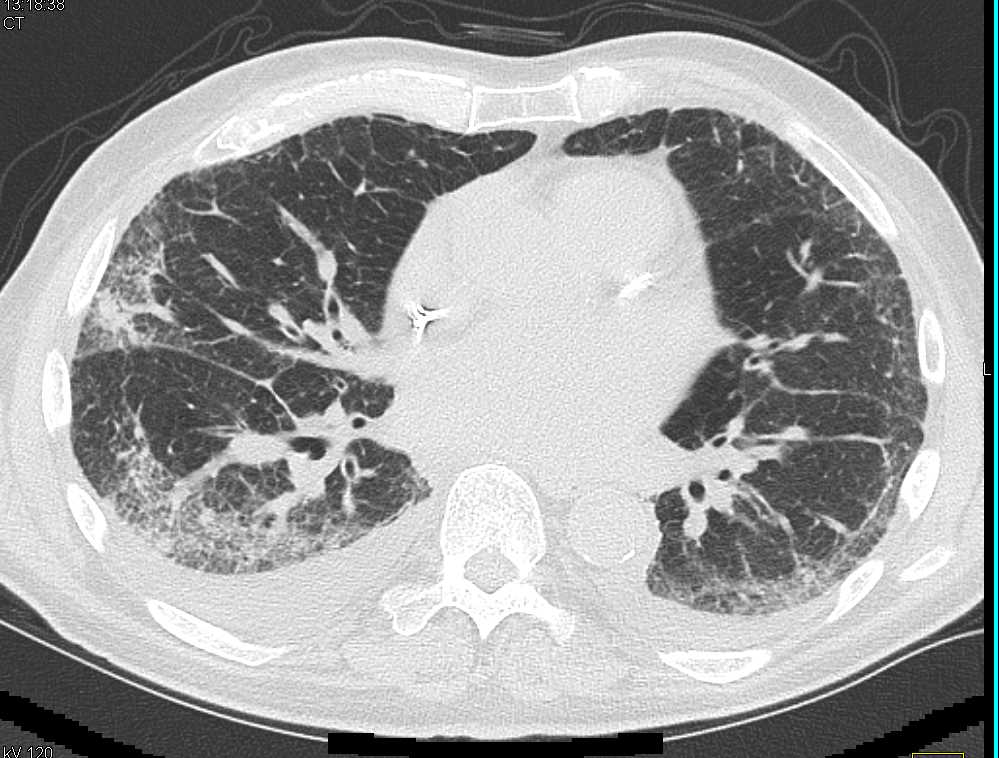 Pulmonary Edema and Interstitial Lung Disease - CTisus CT Scan