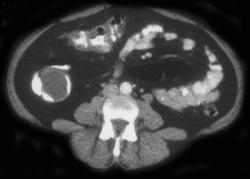 Lipoma Cecum - CTisus CT Scan