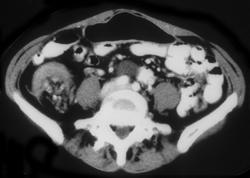 Cecal Adenocarcinoma W/intussusception - CTisus CT Scan