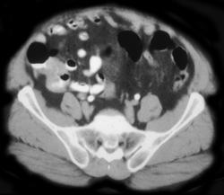 Carcinoma of the Cecum - CTisus CT Scan