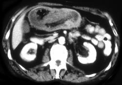 Intussusception Due to Colon Cancer - CTisus CT Scan