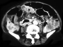 Colon Cancer - CTisus CT Scan