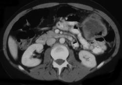 Ulcerating Colon Cancers - CTisus CT Scan